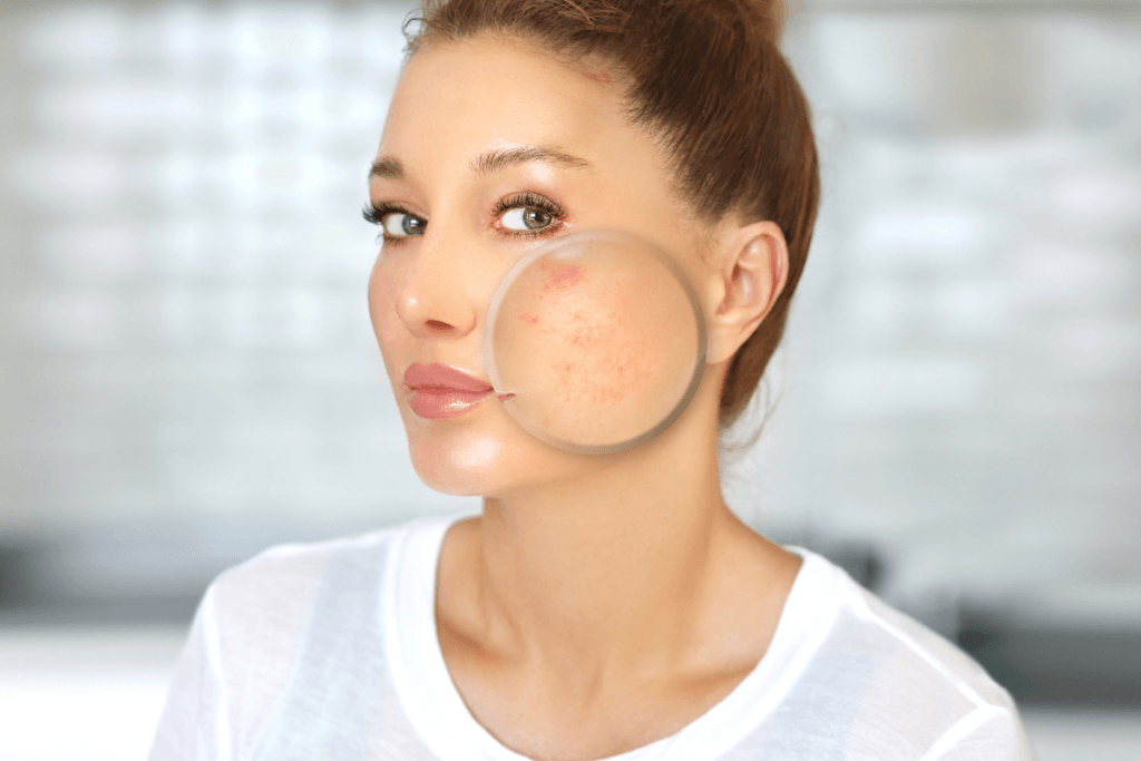 reduzir a inflamação da acne