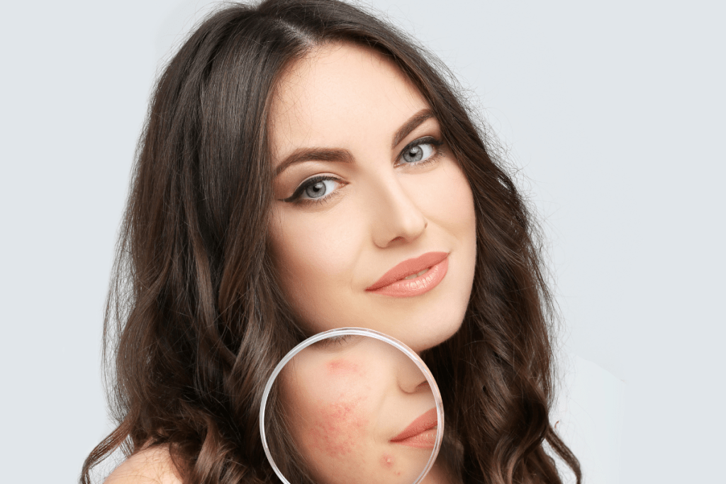 reduzir as cicatrizes de acne